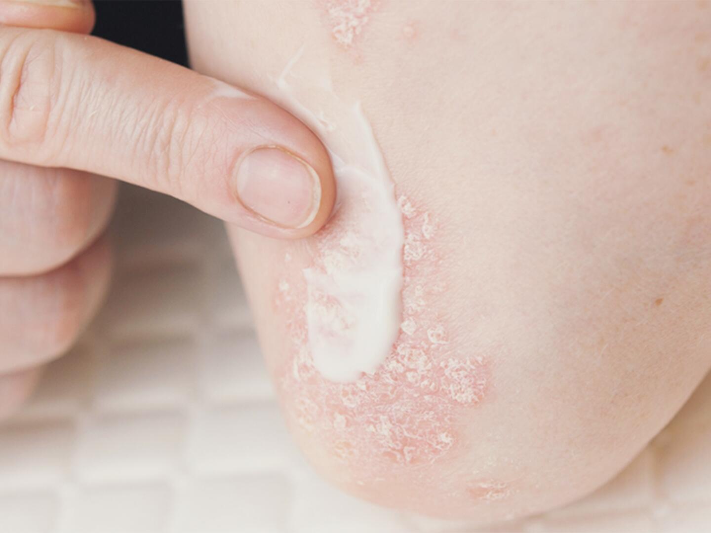 Eine Hand trägt Creme auf einen Ellenbeuge mit Aussschlag auf.